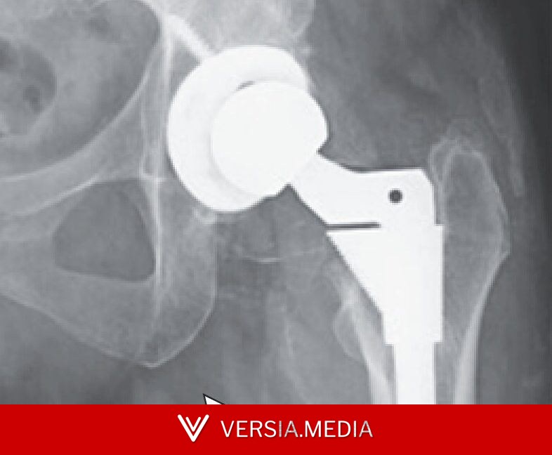 Woman's hip replacement disintegrates, causing severe metal poisoning