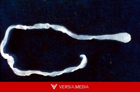 Surprised doctors find 10-inch worm in man's groin during elective surgery