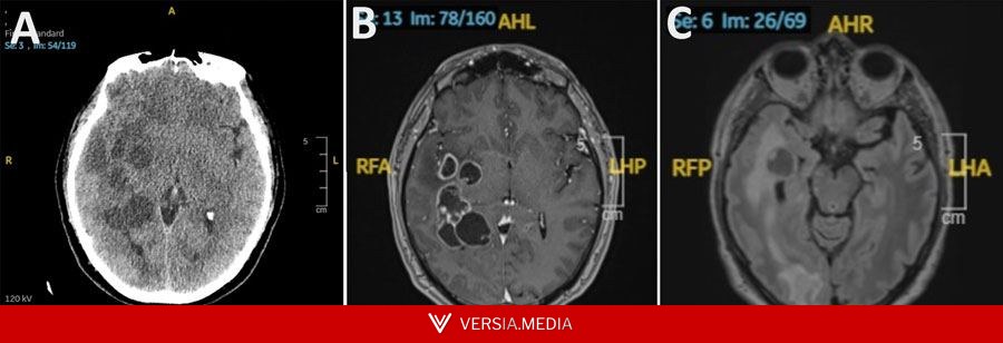 Doctors suspected man had brain cancer. He actually had worms.