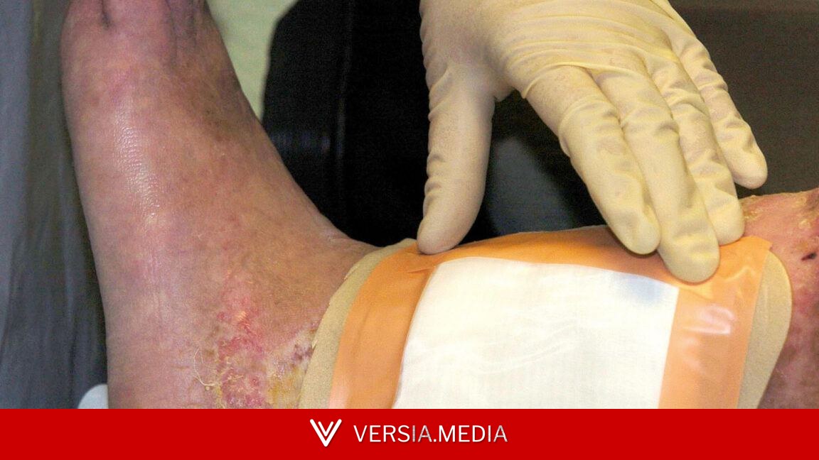 Second carcass-eating fly species cleared by FDA for maggot wound therapy